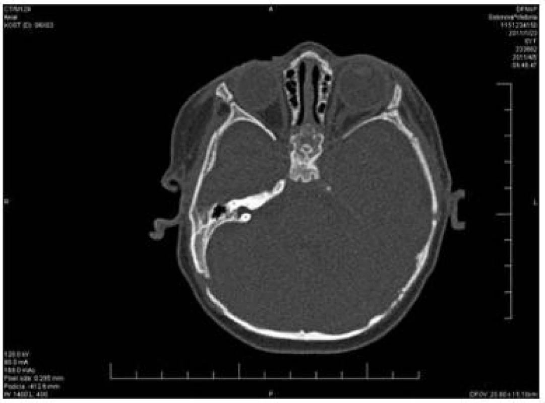 Aplázia zrakového nervu vpravo, CT obraz nativ.