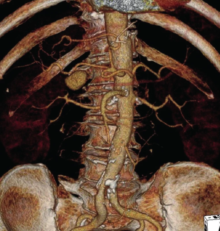 Pseudoaneuryzma a. hepatica v místě odstupu a. gastroduodenalis (3D CT-AG)
Fig. 1: Pseudoaneurysm of hepatic artery at the place where gastroduodenal artery arises (3D-CT AG)