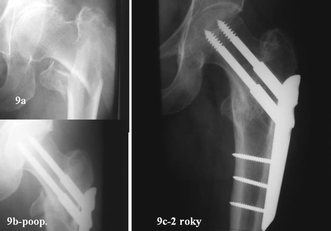 54letá žena. Zlomenina 31A3.3. Úrazový snímek, RTG po operaci a po prohojení za dva roky
Fig. 9a-b. 54- year old female. Type 31A3.3 fracture. Posttraumatic, postsurgical views and a post-healing view after 2 years