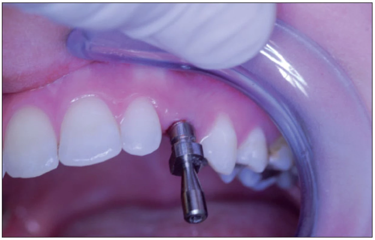 Otiskovací komponent v ústní dutině.