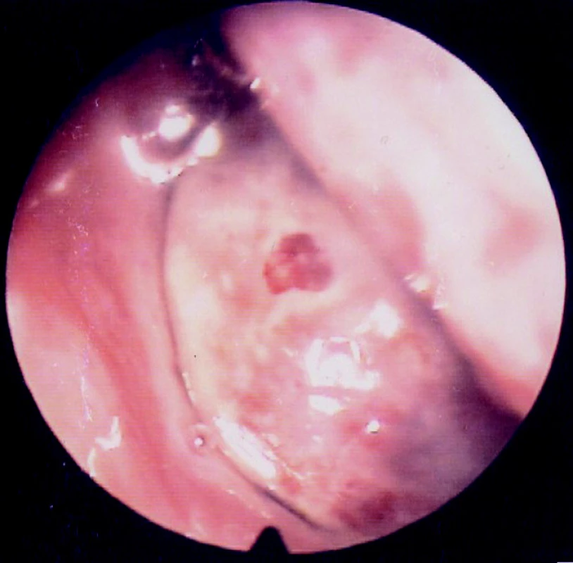 Endoskopický pohled do dutiny nosní zleva