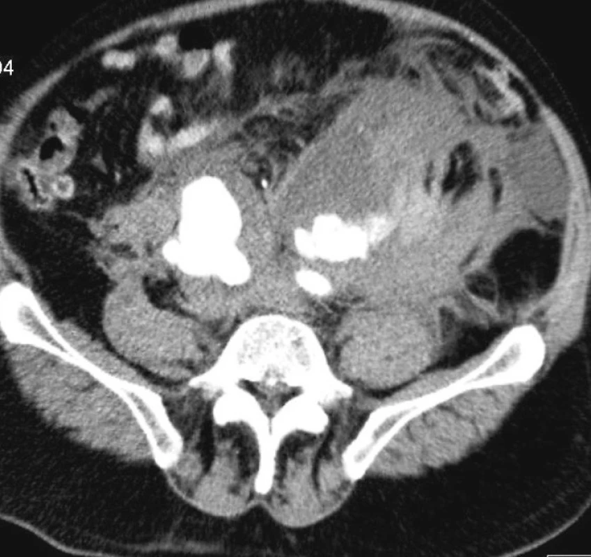 Ruptúrovaná aneuryzma AIC na CT angiografii
Fig. 1. Ruptured aneurysm of common iliac artery on CT – angiography