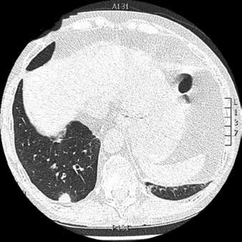 CT hrudníku: kulovité ložisko pravé plíce