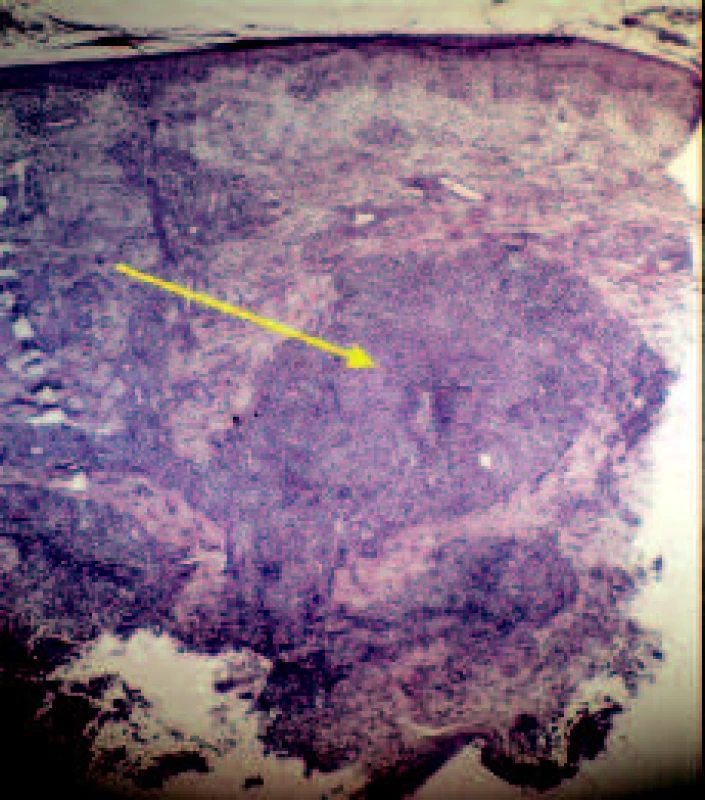 Histologický nález nodulu, šipkou označen granulom z neutrofilů.