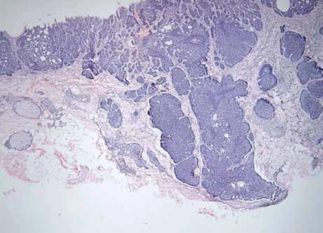 Histomorphological picture of nodular BCC with trichoepithelial growth features (hematoxylin and eosin staining, magnification 40×).