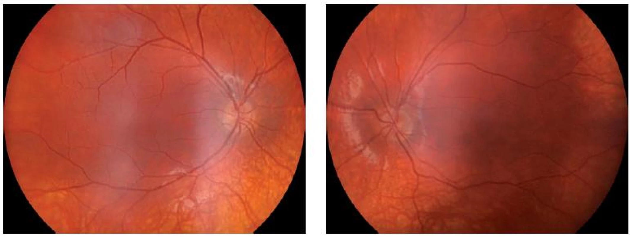 Oční pozadí u pacienta III-1: pravé (A) a levé oko (B); je patrné prořídnutí RPE (retinální pigmentový epitel) v periferii.