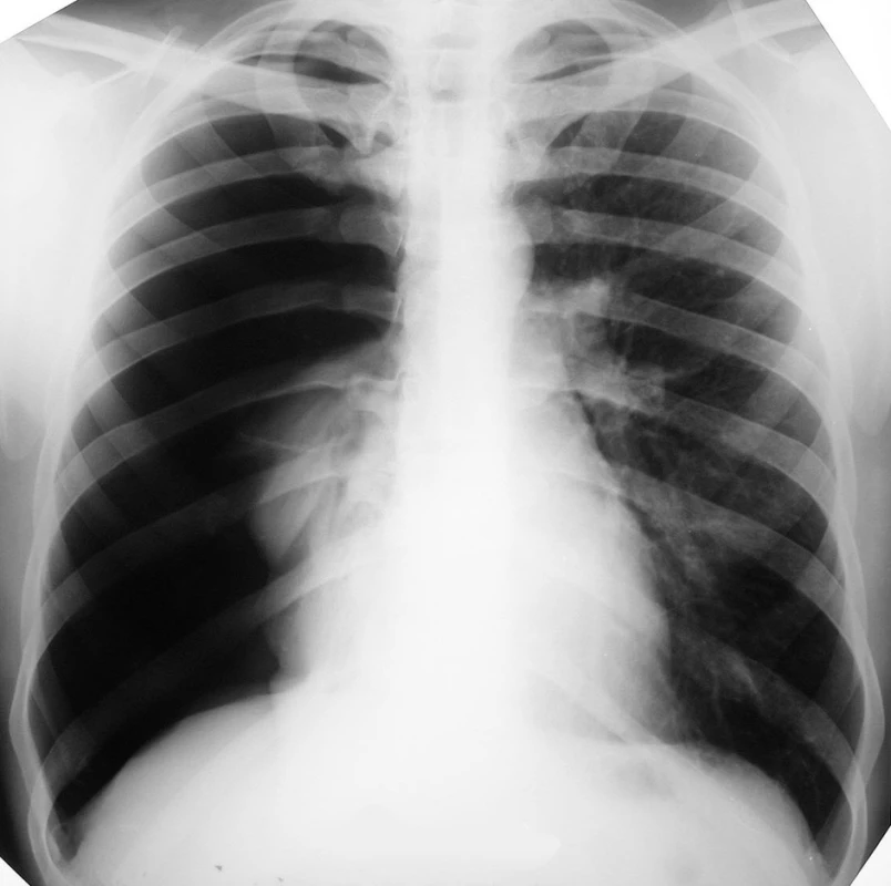 RTG hrudníka pri prijatí, zobrazujúca kompletný spontánny PNO vpravo
Fig. 1. Thoracic X-ray on admission, depicting complete spontaneous pneumothorax on the right
