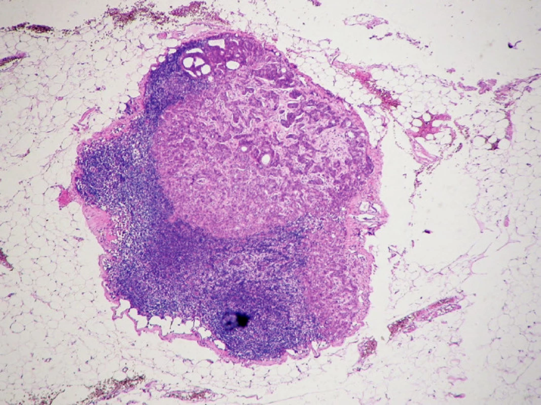 Makrometastáza karcinomu prsu v lymfatické uzlině, obarveno hematoxylinem eosinem
Fig. 1. The breast carcinoma macrometastasis in a lymph node, hematoxylin- eosin staining