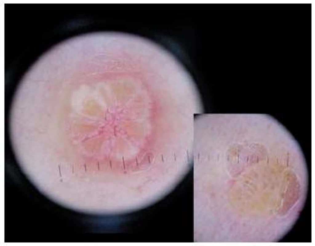 Molluscum contagiosum
(Obrázek – MUDr. Alena Pčolová)