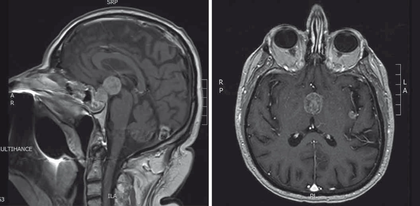 A. MRI hypofýzy (T1 vážené sagitální skeny s kontrastní látkou). Stav po transfenoidální operaci. Progrese velikosti tumorózní expanze. B. MRI hypofýzy (T1 vážené axiální skeny s kontrastní látkou). Stav po radioterapii. Supraselární tumorózní expanze, menší tumorózní ložisko v oblasti inzuly vlevo.