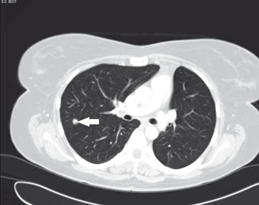 Bílá šipka – metastáza CRC v pravém horním plicním poli.
Fig. 3. White arrow – colorectal cancer metastasis in right upper lung lobe.