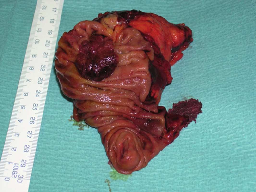 Exophytically growing adenocarcinoma of the papilla of Vater – resected specimen