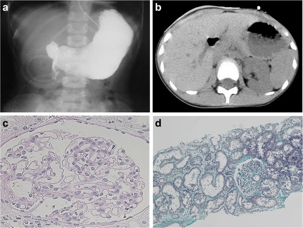 Findings in the large intestine and kidney in the present patient. Total-colon HSCR (a) and right renal agenesis (b) were present. On histologic examination of the kidney, very few glomeruli (0.96/μm2) were present, and glomeruli and renal tubules were enlarged (c Periodic acid-Schiff stain, x400 and d Masson trichrome stain, x100)