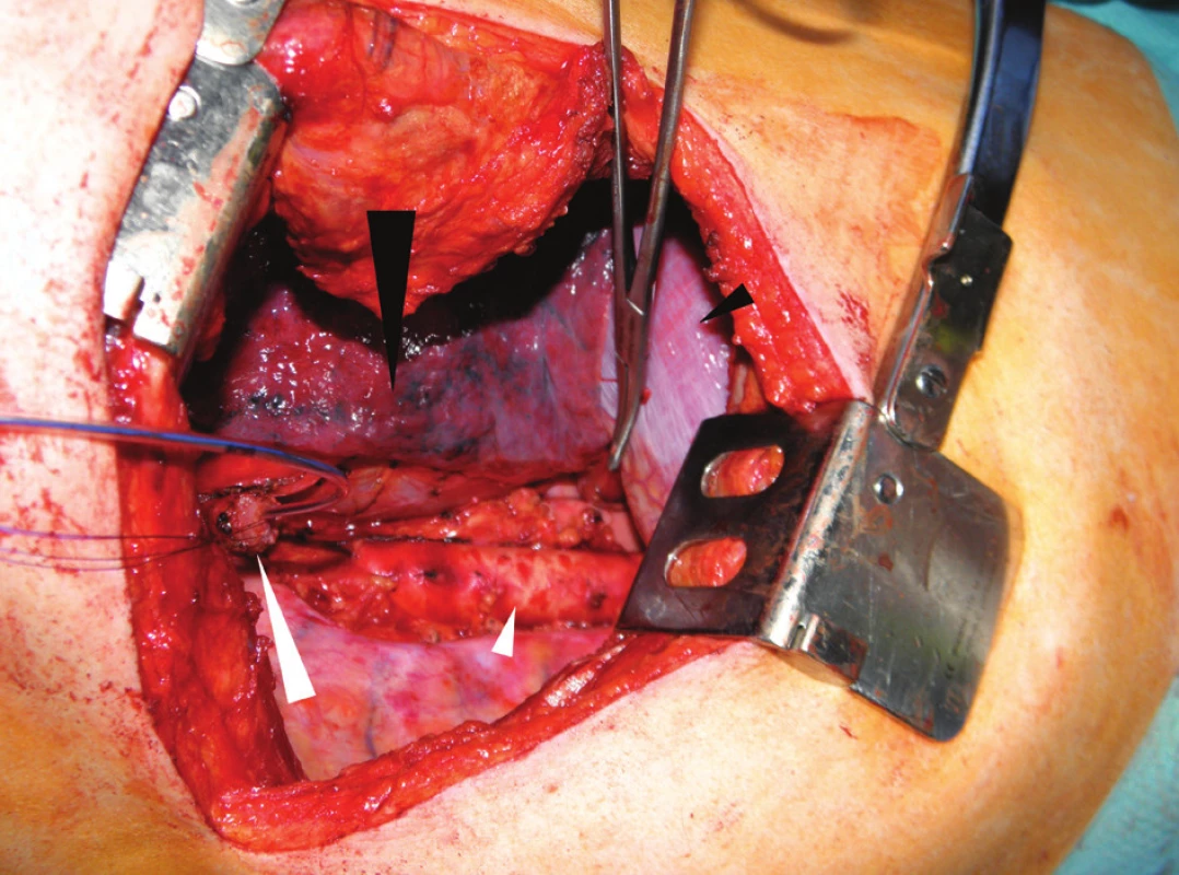 Operační nález při pravostranné thorakotomii: jícen přerušený nad nádorem s enterální sondou (velká bílá šipka), aorta po odstranění tukové tkáně s uzlinami po radikální lymfadenektomii (malá bílá šipka), pravá plíce (velká černá šipka) a bránice (malá černá šipka)
