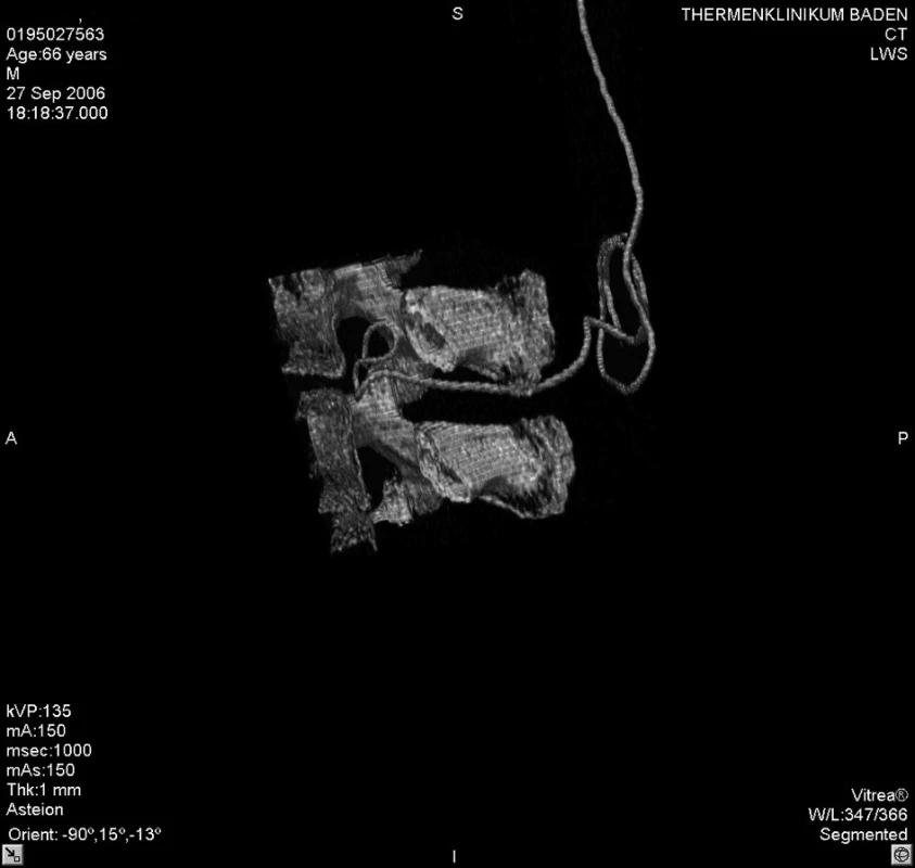 3D zobrazení polohy epidurálního katétru mezi L2–3, pohled z levé strany