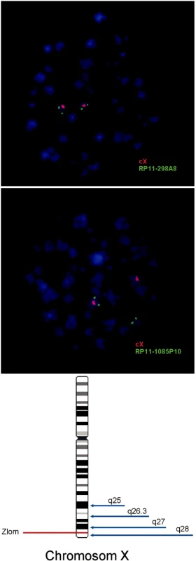 Schematické znázornenie mapovania a určovania lokalizácie zlomu na chromozóme X u detskej pacientky s ALL asociovanou s prestavbou 11q23. Pomocou FISH sa potvrdila translokácia génu MLL s partnerským X chromozómom (nie je ukázané). A. Výsledok FISH s BAC sondou RP11-298A8, ktorá mapuje do oblasti Xq27 a je značená zeleným fluorochrómom, a zároveň s centromerickou sondou CEPX (Abbott-Vysis), ktorá je značená červeným fluorochrómom. Lokalizácia BAC sondy na X chromozóme potvrdzuje, že zlom nenastal v pruhu q27. B. Mapovanie oblasti Xq28 pomocou BAC sondy RP11- 1085P10 značenej zeleným fluorochrómom a centromerickej sondy CEPX (Abbott-Vysis) značenej červeným fluorochrómom. Lokalizácia signálu BAC sondy na inom chromozóme (chromozóm 11) potvrdzuje zlom X chromozómu v pruhu q28. C. Mapa X chromozómu znázorňuje zlom v pruhu q28. Fúzia MLL génu s Xq28 nebola doteraz popísaná.