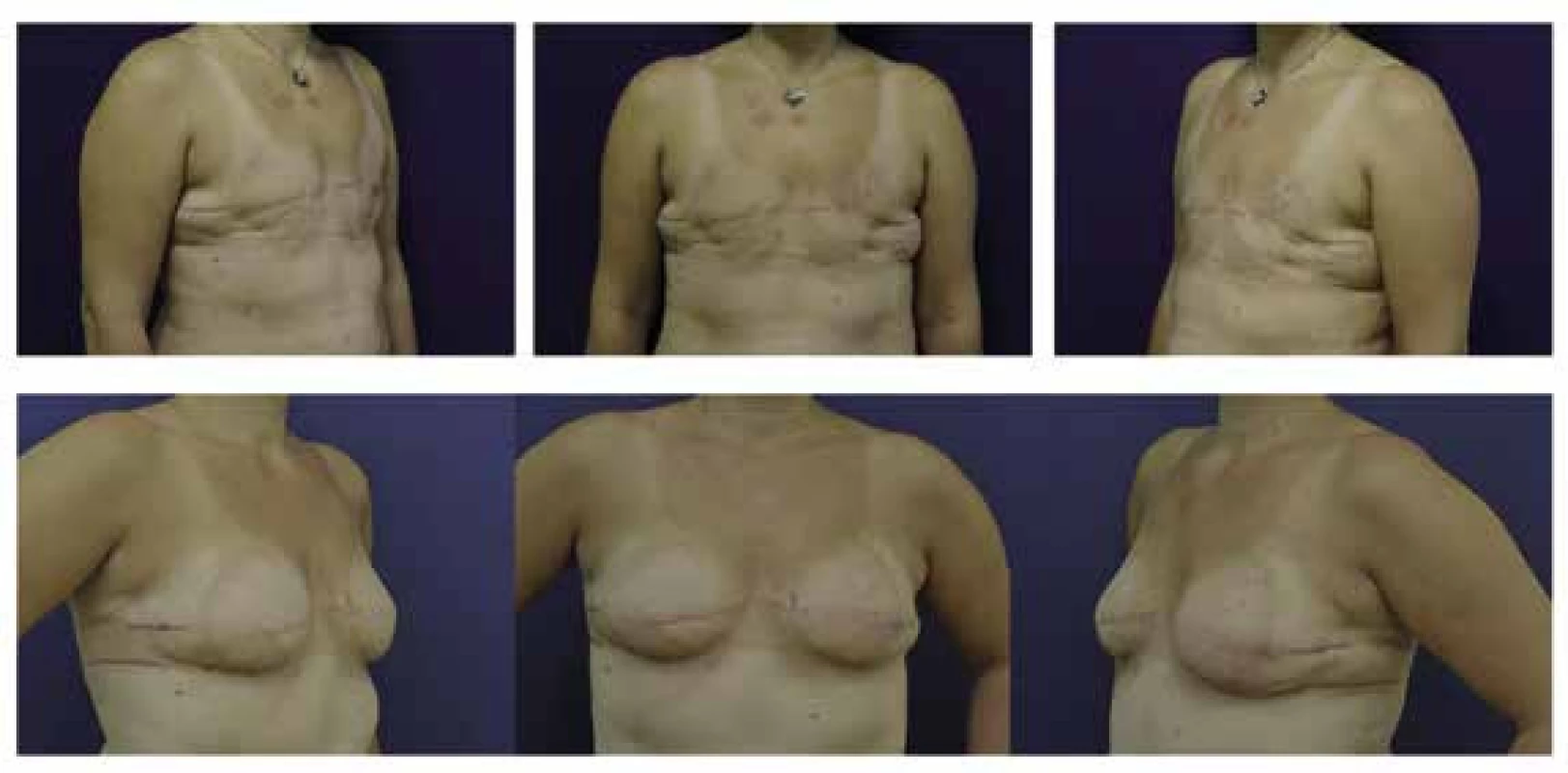 Rekonstrukce prsu přenosem vlastní tukové tkáně u pacientky po bilaterální mastektomii