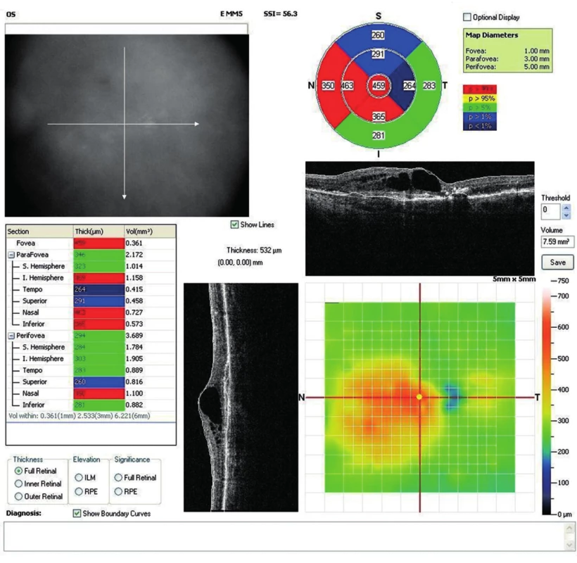OCT snímok (mapa) ľavého oka. Výrazný edém neuroretiny s makrocystickou premenou v mieste fovey. Výrazné atrofické zmeny RPE, až počínajúca fibrotická premena. Nález po 15 intravitreálnych dávkach ranibizumabu