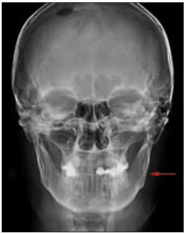 RTG hlavy. Mírné zneostření architektoniky spongiózy levého rámu dolní čelisti a ve srovnání i levé maxily, jinak bez strukturálních změn kalvy.
