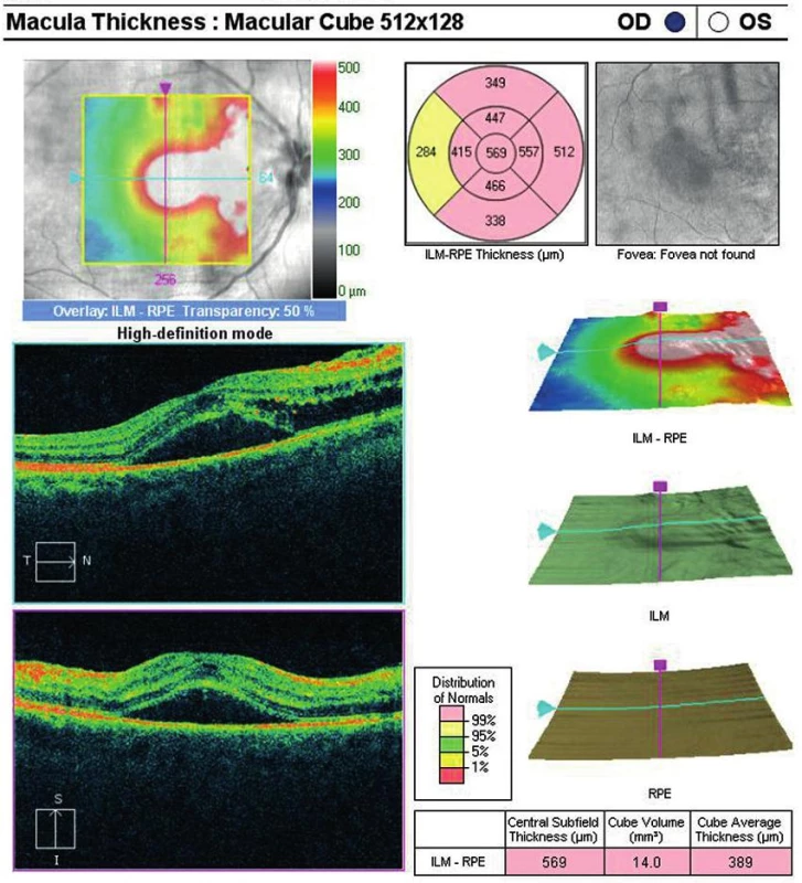 OCT centrální krajiny oka pravého. Nález volné tekutiny mezi neuroretinou a retinálním pigmentovým epitelem (RPE), edém neuroretiny, který pokračuje směrem k terči zrakového nervu.