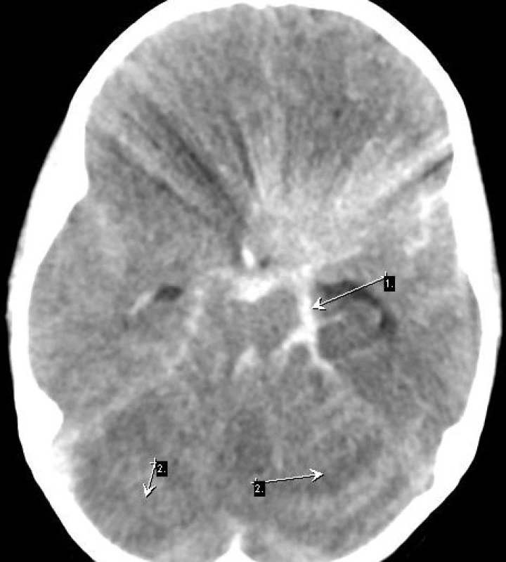 Maligní edém mozku bez subarachnoideálních prostor zde masivně SAK (1), difuzně hypodenzní parenchym mozku s ischémií obou mozečkových hemisfér (2)