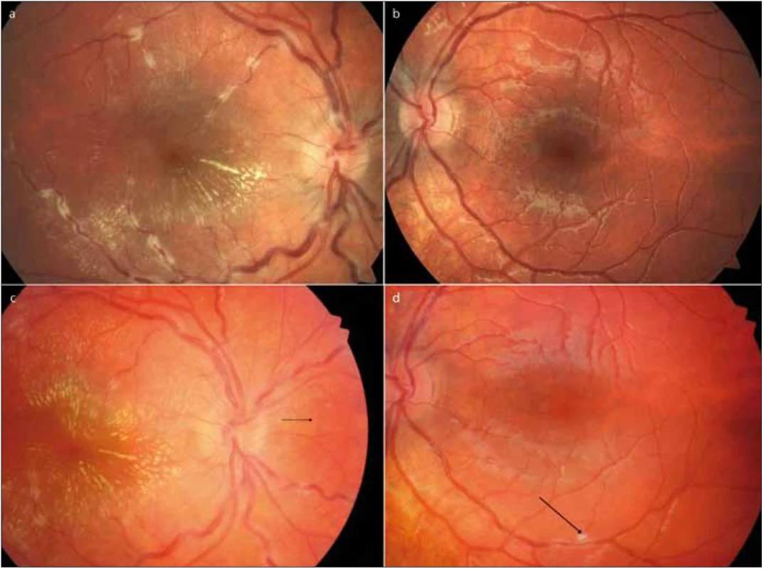 V horní polovině vstupní vyšetření pravého a levého oka (1a, b), dolní levý obrázek vstupní vyšetření pravého oka na našem pracovišti (1c), suspektní granulomy sítnice tzv. Landers sign (šipka, 1c), vpravo dole levé oko s novým chorioretinálním infiltrátem (šipka 1d).