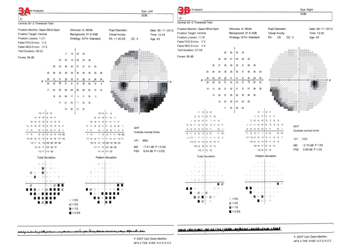 Perimetrické vyšetření u pacienta č. 4. 3A – OL – obloukovitý dolní nazální skotom, relativní horní temporální skotom, 3B – OP – dolní nazální skotom