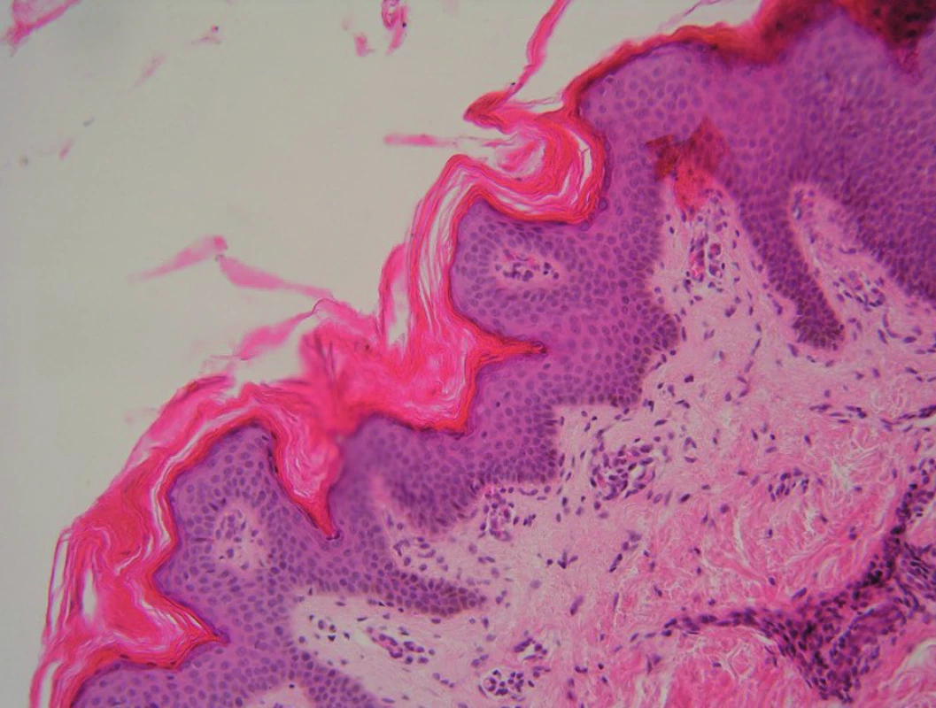 Histologie – případ 3: zesílená ortokeratotická rohová vrstva, akantotická epidermis, náznak papilomatózy (HE, zvětšení 200krát).