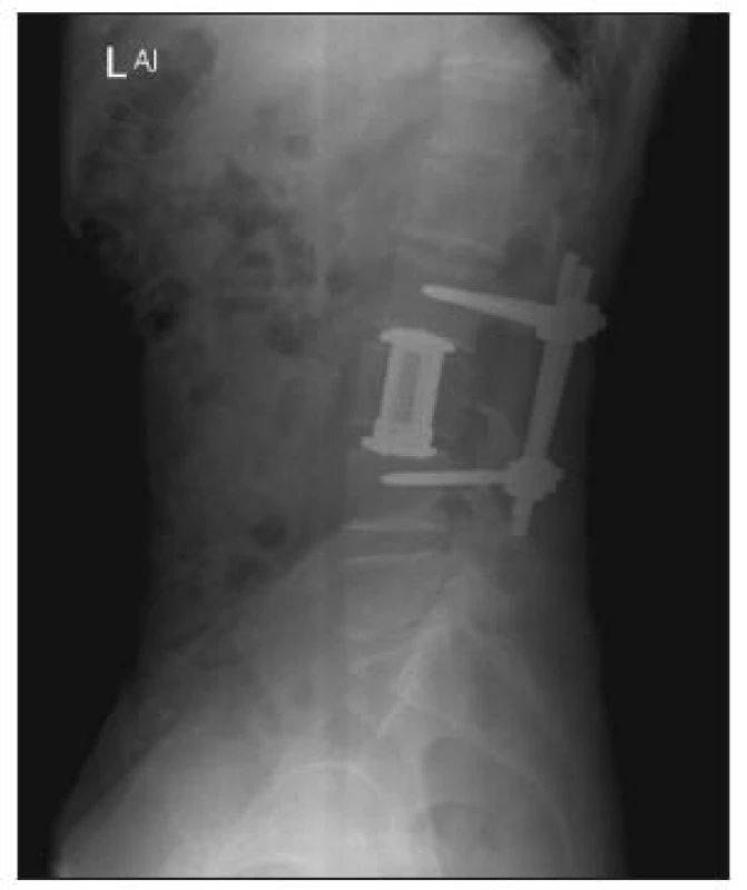 Skiagram lumbosakrální páteře, bočný. Pooperační stav po kombinované stabilizaci obratle L3
Fig. 4. Plain x-ray, lumbosacral spine, lateral view. Postoperative examination following combined L3 stabilization