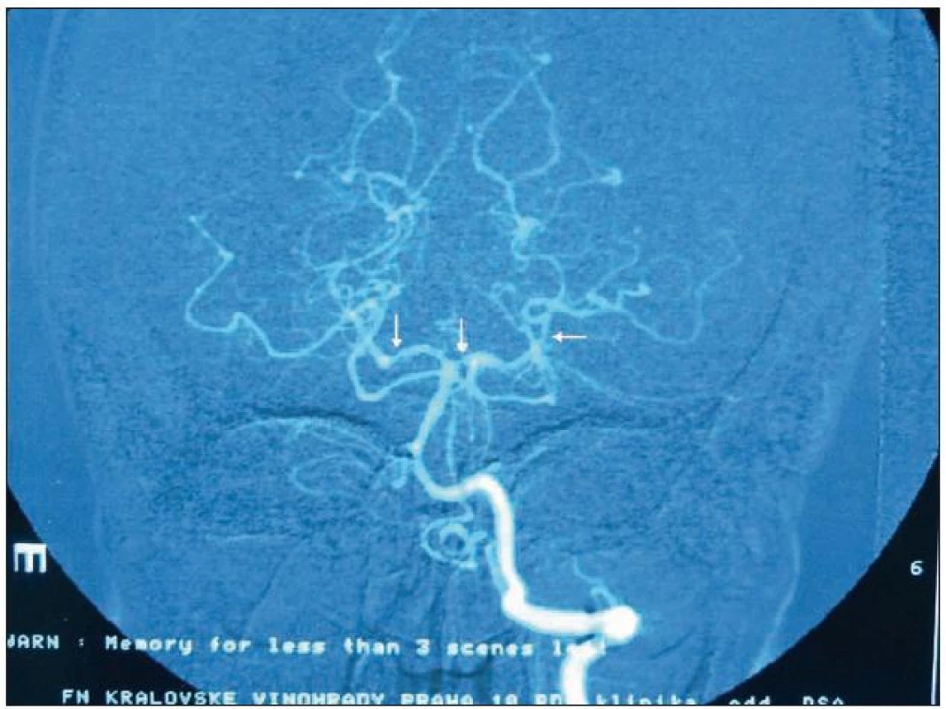 DSA obraz segmentálních stenóz (vazospazmů) na zadních mozkových tepnách u pacientky s RCVS.

