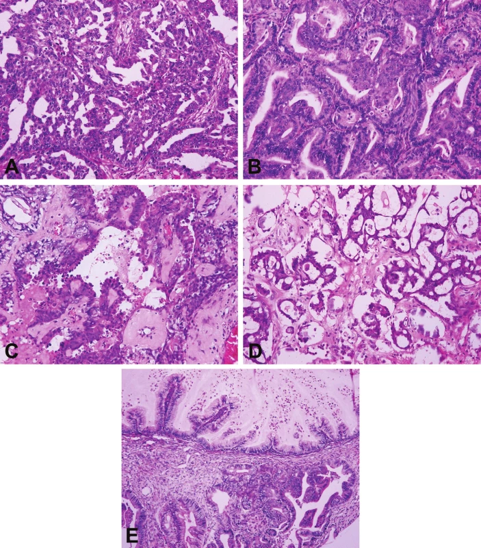 Histologický vzhled pěti základních typů karcinomů ovaria.