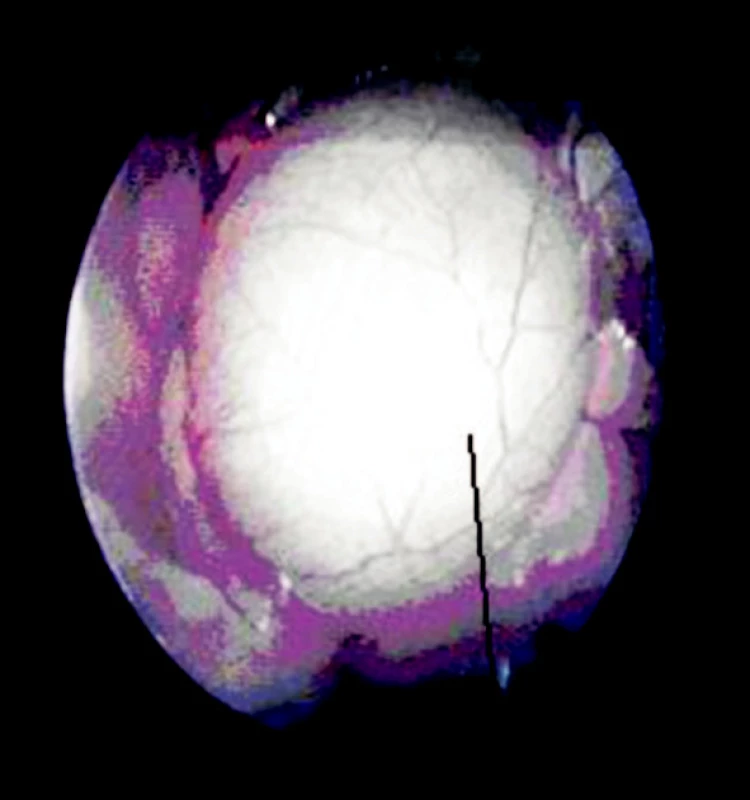VTS pohled na parakardiální cystu
Fig. 11 VTS view of the paracardial cyst