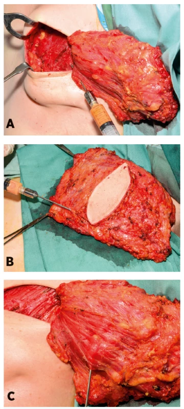 Application of the processed fat (a) into the pectoralis muscle and (b, c) into the latissimus dorsi muscle