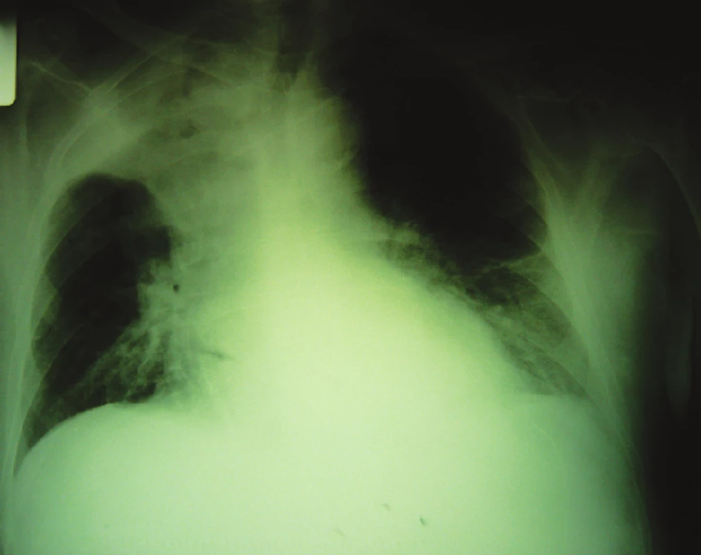 RTG nález tumoróznej masy v pravom hornom pľúcnom poli
Fig. 5. RTG finding of a tumorous mass in the right upper lung region