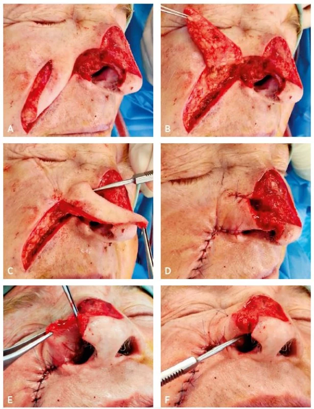 A–F. Sequence of nasal lining reconstruction with transposition nasolabial flap
