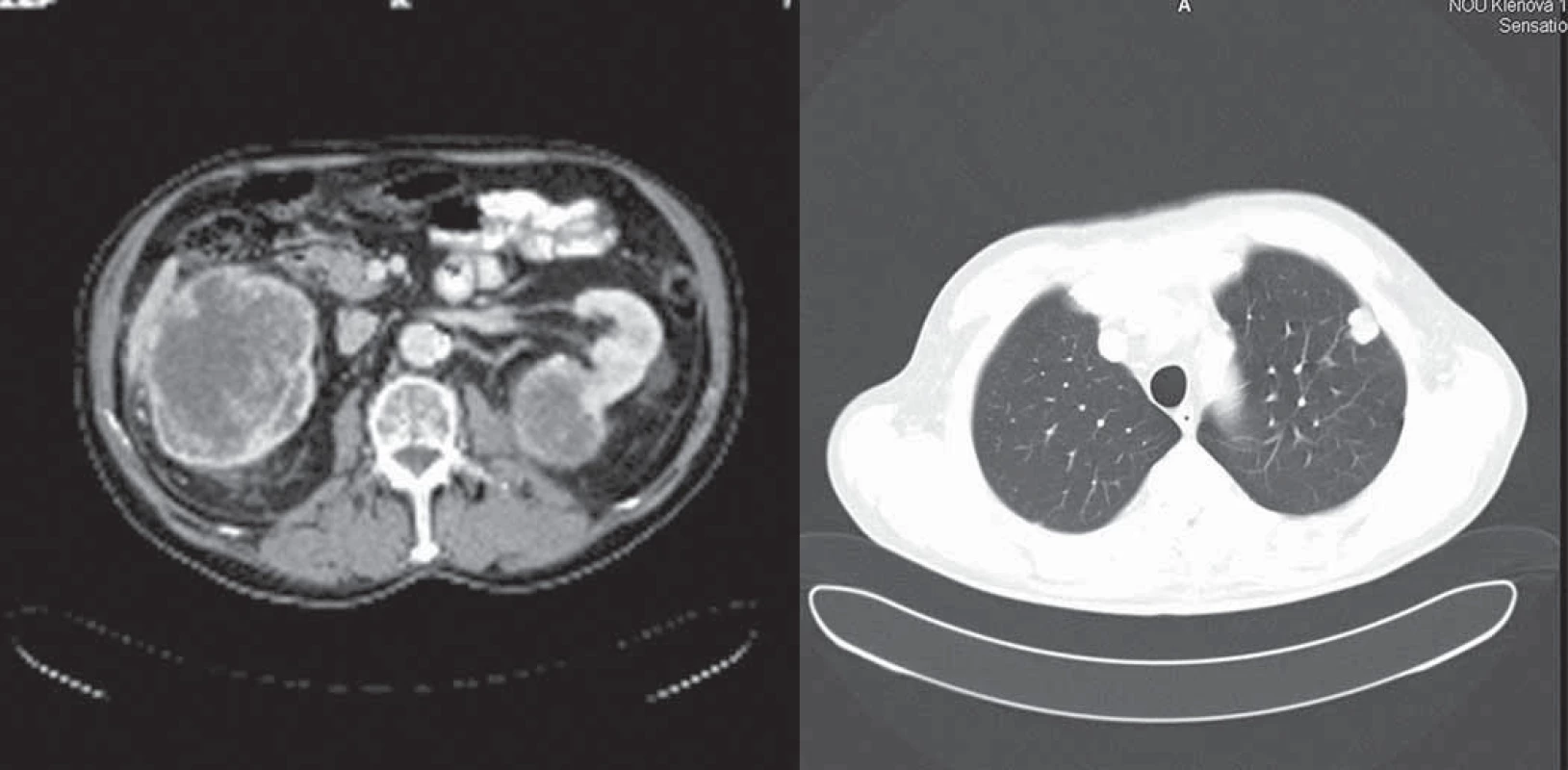 CT vyšetrenie hrudníka a abdomenu 4. 2. 2009.