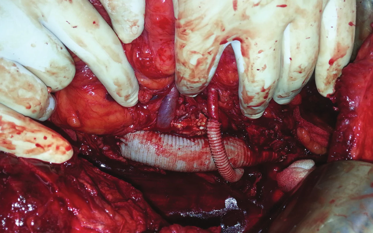 Náhrada aorty s byppasem na pravou i levou renální tepnu
Fig. 7: Aortic replacement with bypass to right and left renal artery