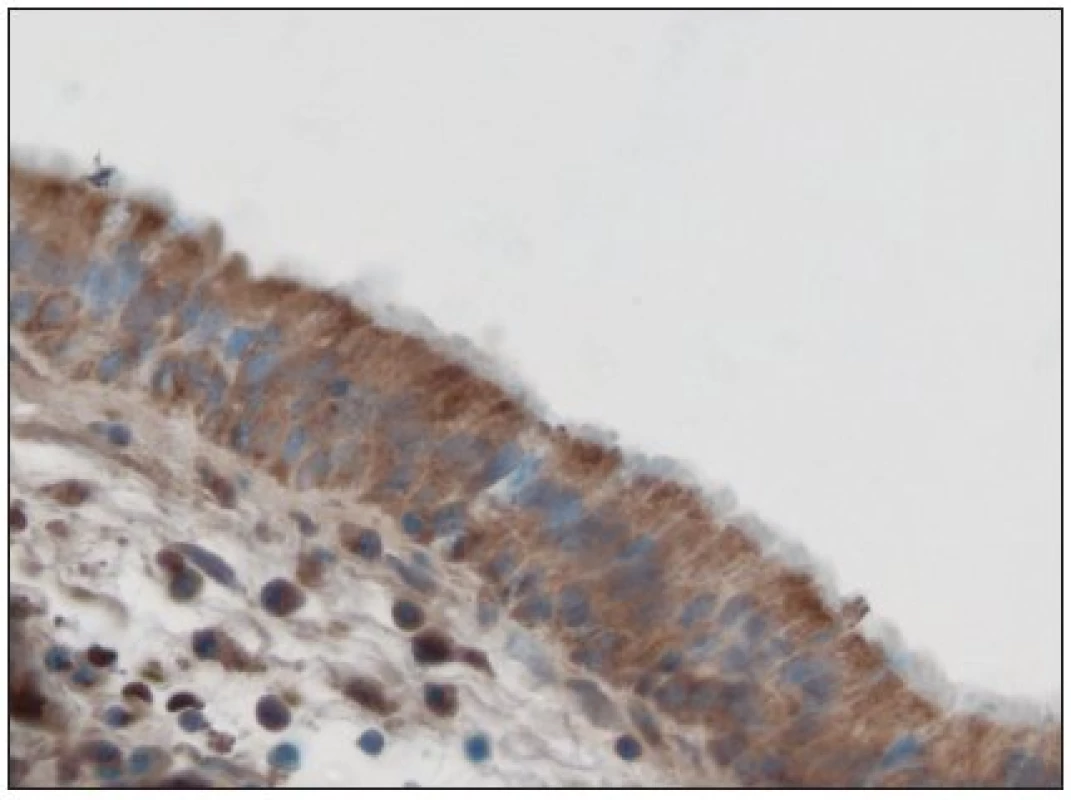 Významně větší nakupení reakčního produktu HBD- 3 v buňkách povrchového víceřadého cylindrického epitelu ve sliznici polypu s prokázaným Staphylococcus pyogenes aureus. Imunoperoxidázová reakce (DAB). Dobarveno hematoxylinem. Obj. 63x.