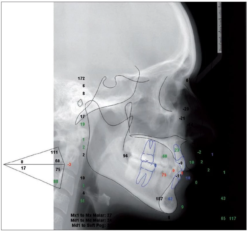 Ukázka McLaughlinovy kefalometrické analýzy – program Dolphin Imaging