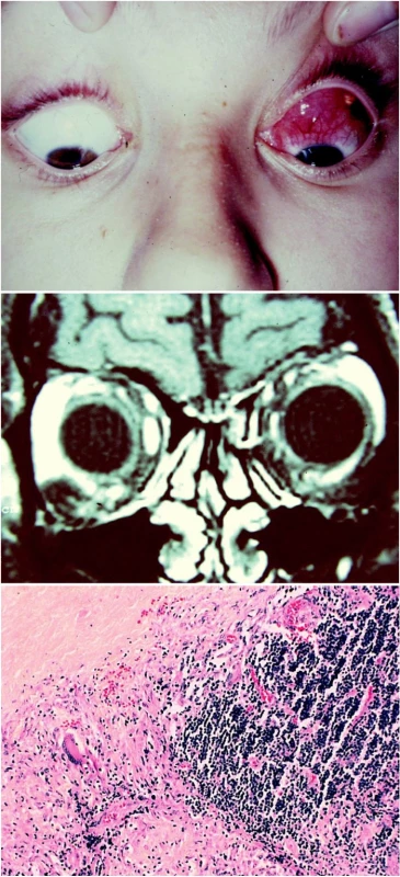 a. Nodulární tumor pod spojivkou vlevo
b. MR: plášťovité zduření pod stropem levé očnice
c. Histologie: Lipogranulom orbity, parafin. řez, barvení Gi- Obr. 2c. Normalizace polohy oka po kortikosteroidní terapii emsa, zvětšení 125krát
