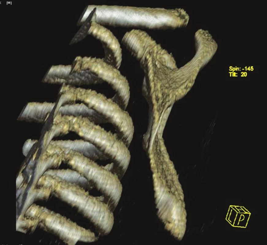 CT rekonštrukcia skapuly – bočný pohľad
Fig. 3. CT reconstruction of the scapula – a lateral view