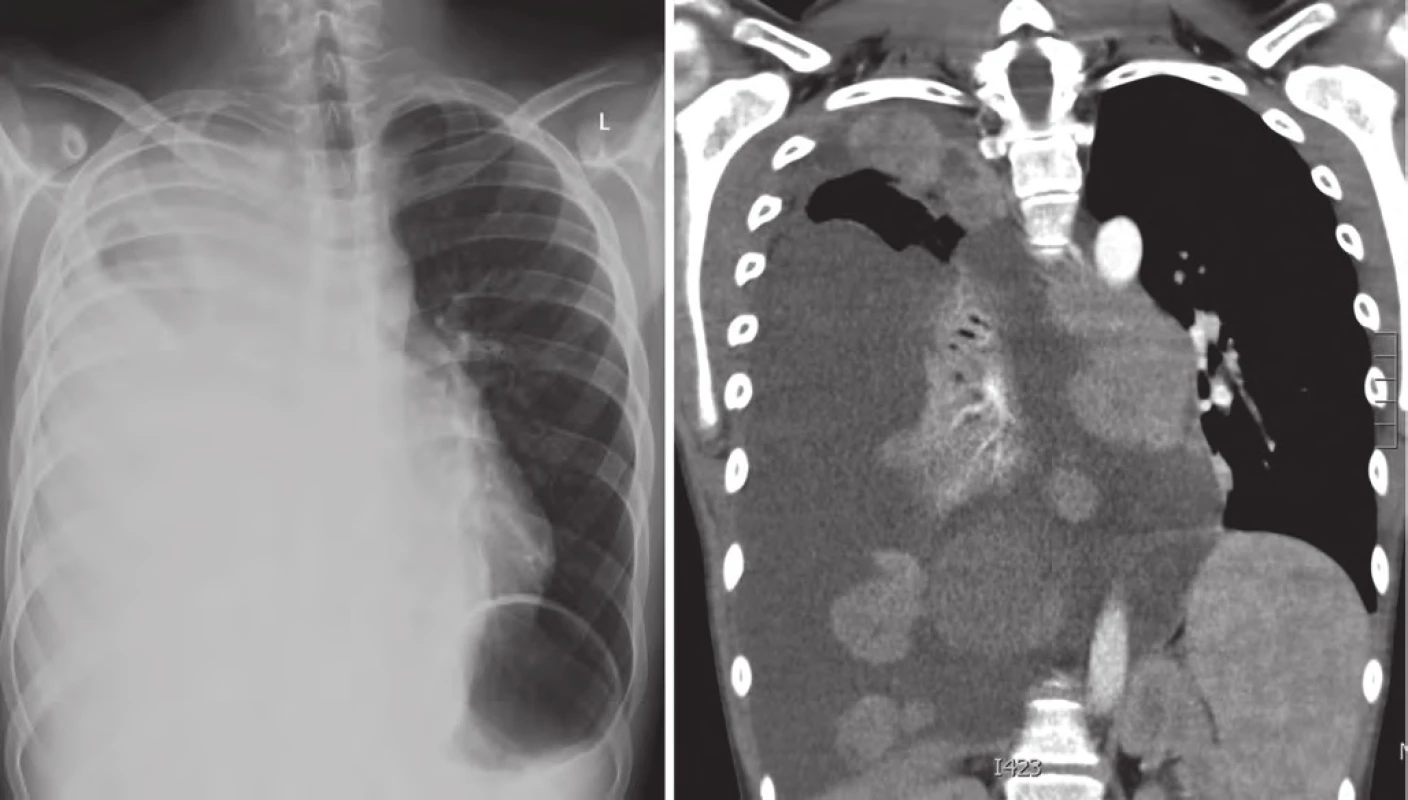 Progrese v plicích a mediastinu, pleurální výpotek, duben 2015.
