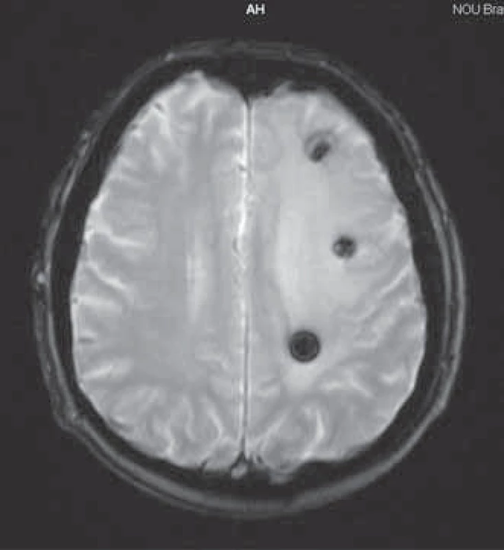 Magnetická rezonancia mozgu 3. 9. 2008.