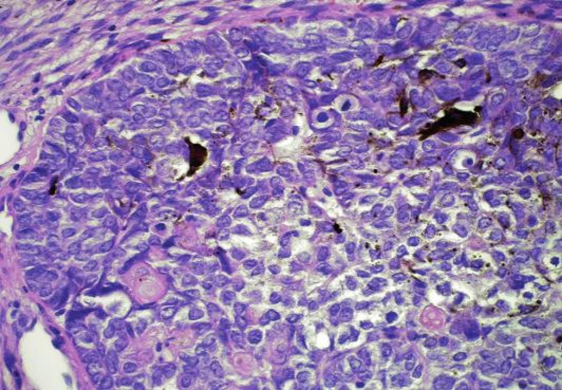 Solidní čep matrikálních buněk s rozptýlenými dendritickými melanocyty (nahoře) a okrouhlými eosinofilními stínovitými buňkami (dole) (HE, původní zvětšení 400x).
