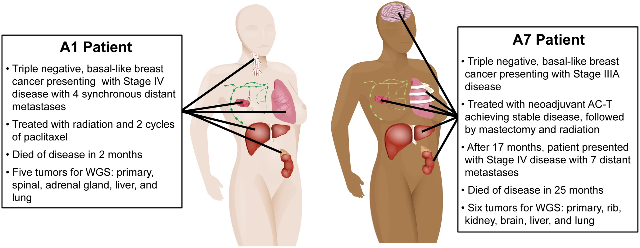 Clinical history and distribution of metastases from patients A1 and A7, who both had clinically triple-negative and basal-like breast cancer.