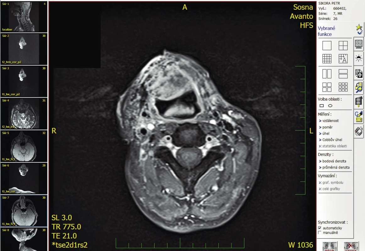 Řez MRI vyšetření s patologickou masou měkkých tkání vlevo v oblasti hypofaryngu