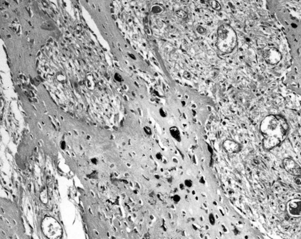 Ojedinělé S-100 protein pozitivní osteoblasty na povrchu trámečku nově vytvořené nelamelární kosti. Naproti tomu uvnitř trámečku se pozitivně znázornily perzistující oválné chondrocyty a vřetenité osteocyty (120krát)
