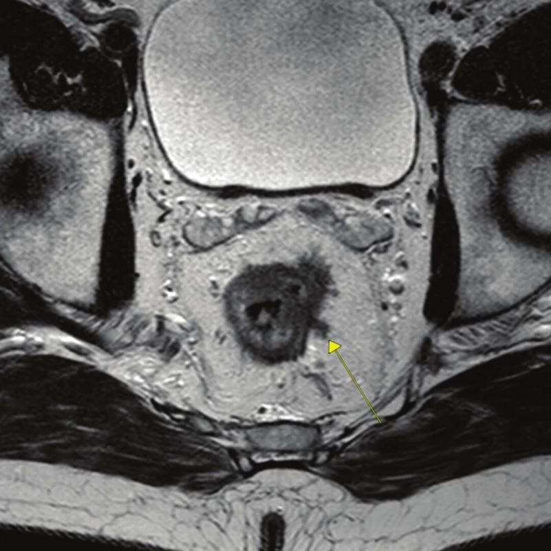Ložisko extramurální vaskulární invaze (označeno šipkou)
Fig. 1: A vein with eMVI on MRI image (see arrow)