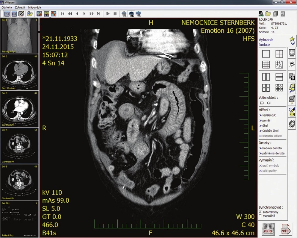 CT s infiltrovanou kličkou tenkého střeva
Fig. 2: CT with infiltrated small intestine