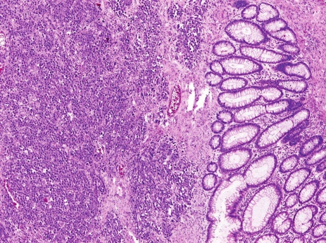 Histopatologický obraz maligního lymfomu tračníku typu plasmocytomu
Fig. 6: Histopathological finding of malignant lymphoma of the plasmocytoma type